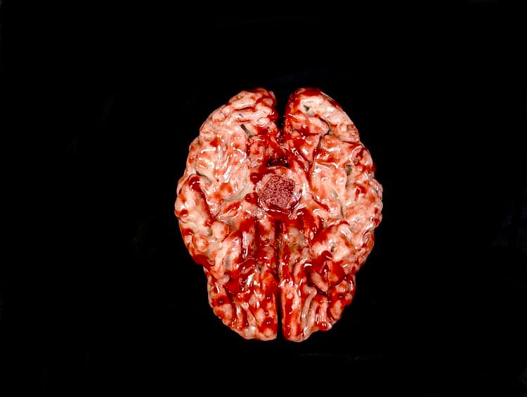 BP- Large Brain
